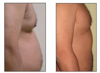 liposukce 7
