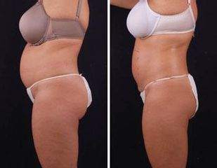 exilis1