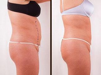 exilis2