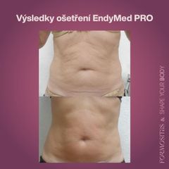 Lipolýza - FORMOSITAS - Klinika estetické medicíny, s.r.o.