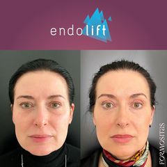 Neinvazivní lifting obličeje - FORMOSITAS - Klinika estetické medicíny, s.r.o.