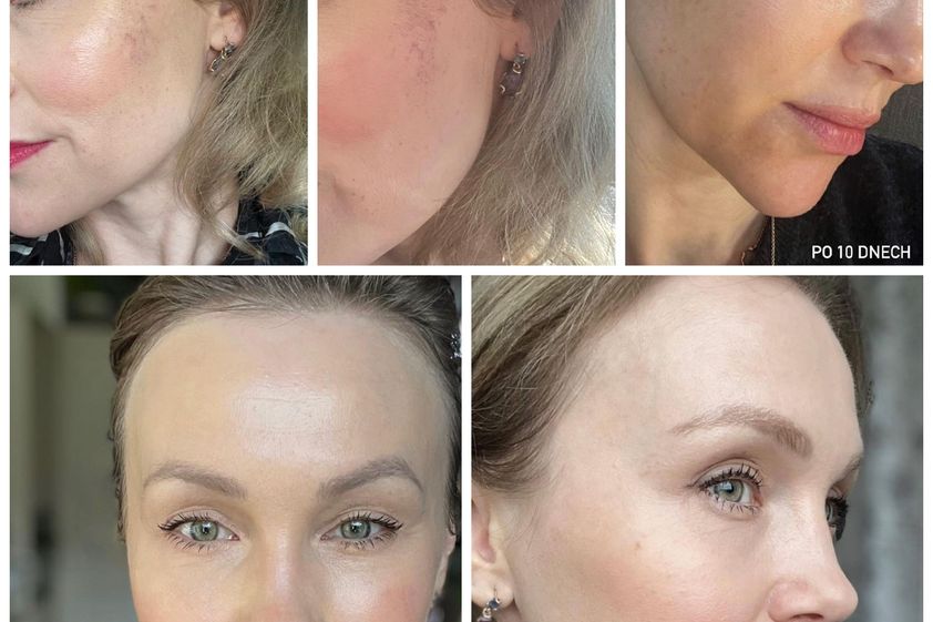 Fotorejuvenace IPL před a po - 856977