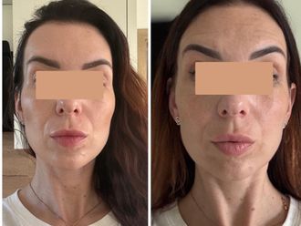 Neinvazivní lifting obličeje před a po - 876647