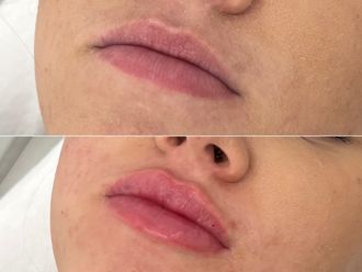Zvětšení rtů kyselinou hyaluronovou před a po - 876649