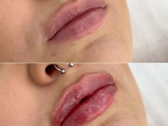 Zvětšení rtů kyselinou hyaluronovou před a po - 876651