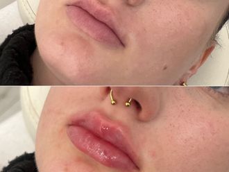 Zvětšení rtů kyselinou hyaluronovou před a po - 876911