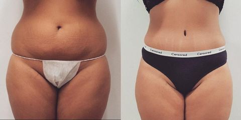 Lipoabdominoplastika