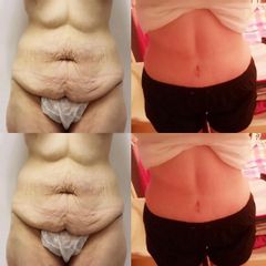Liposukce + abdominoplastika