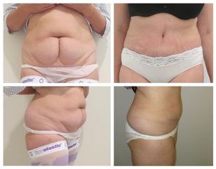 abdominoplastika