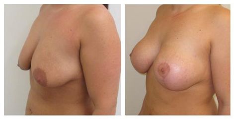 modelace+implantát