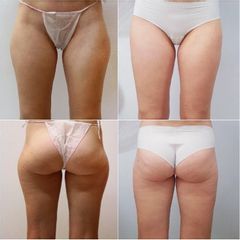 Liposukce vnějších stehen