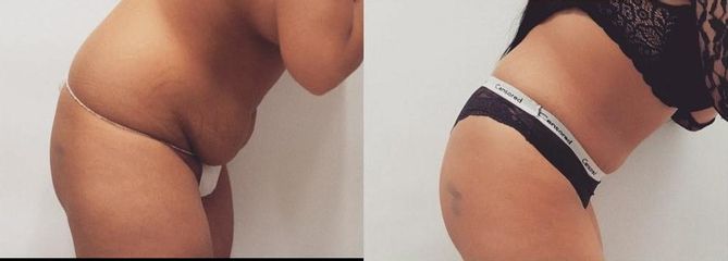Lipoabdominoplastika