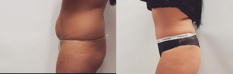 Lipoabdominoplastika