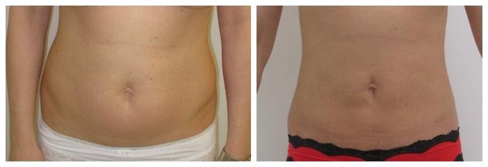 Slimlipo břicho