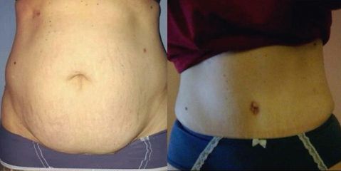 Abdominoplastika