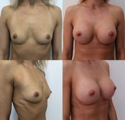 Zvětšení prsou - MUDr. Juraj Payer Ph.D., FEBOPRAS