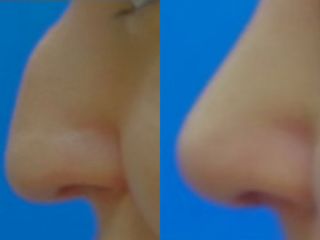 Rhinoplastika - RVmedCentrum privátní klinika s.r.o.