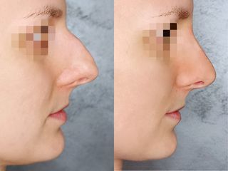 Rhinoplastika - RVmedCentrum privátní klinika s.r.o.