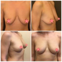 mastopexy