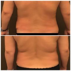 lipo1