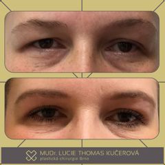 Operace očních víček - MUDr. Lucie Thomas Kučerová