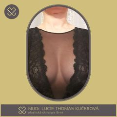 Zvětšení prsou - MUDr. Lucie Thomas Kučerová