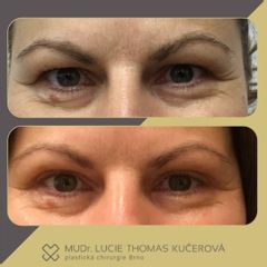 Operace očních víček - MUDr. Lucie Thomas Kučerová