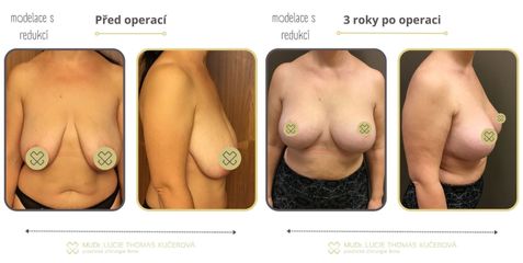 Modelace prsou s augmentací - MUDr. Lucie Thomas Kučerová