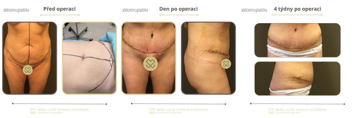 Abdominoplastika - MUDr. Lucie Thomas Kučerová