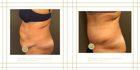 Abdominoplastika - MUDr. Lucie Thomas Kučerová