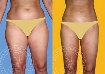 lipo1
