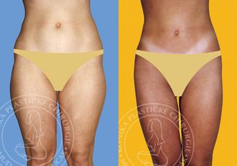 lipo3