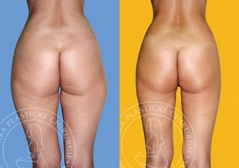 lipo5