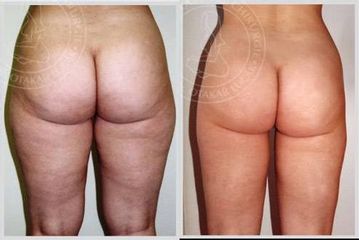 liposukce odsavani tuku 1aaa