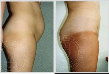 liposukce odsavani tuku 3a