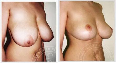 zmenseni modelace prsou 2a
