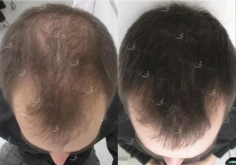 Vlasová mezoterapie