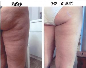 Ošetření bezbolestnou liposukcí