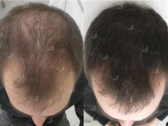Vlasová mezoterapie - 722681
