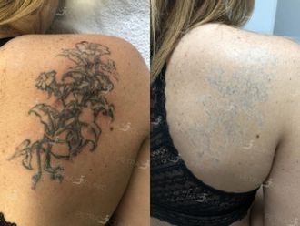 Odstranění tetování - 722690