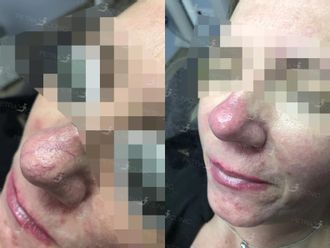 Laserové odstranění rozšířených žilek před a po - 722691