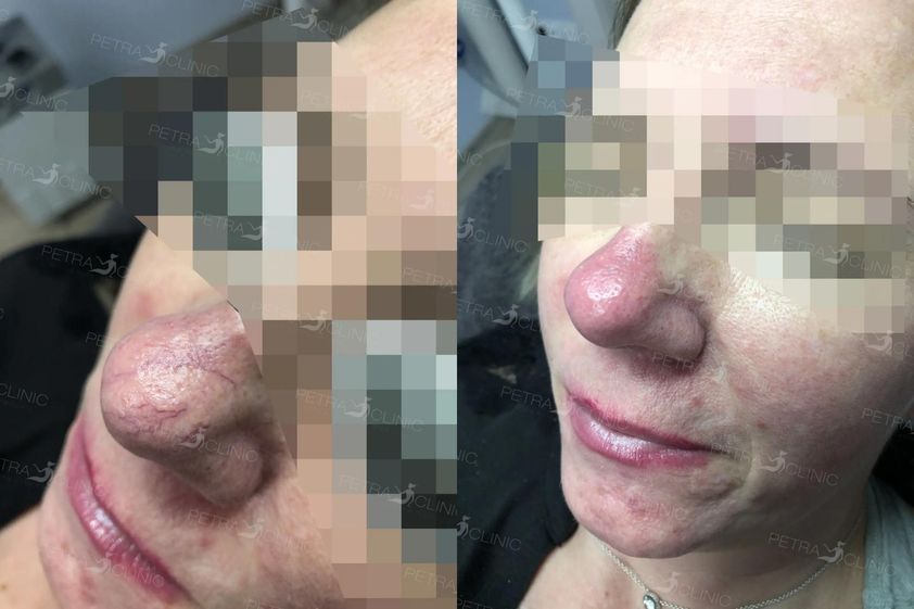 Laserové odstranění rozšířených žilek před a po - 722691