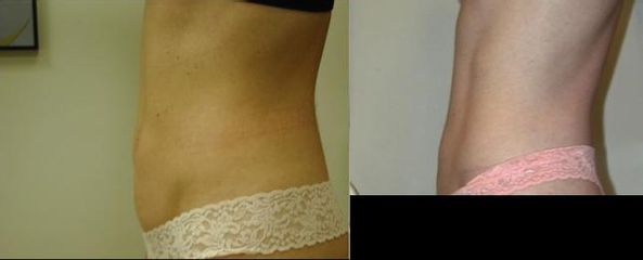 Liposukce radiofrekvenční