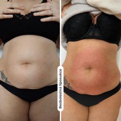 Bezbolestná liposukce - Klinika estetické a laserové medicíny Petra Clinic