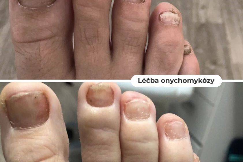Nehtová plíseň před a po - 824122