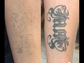 Odstranění tetování - 837568