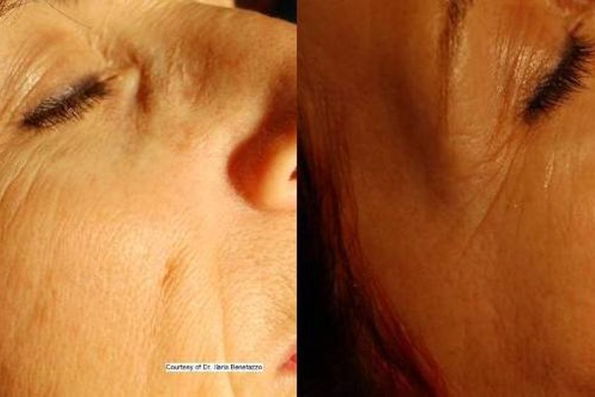 Biostimulační laser před a po - 729483
