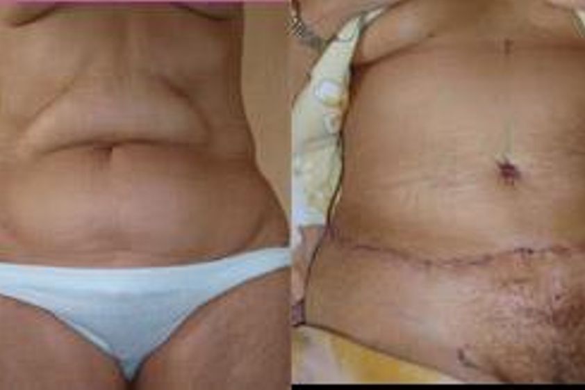 Abdominoplastika před a po - 718869