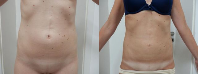 LIPO A1