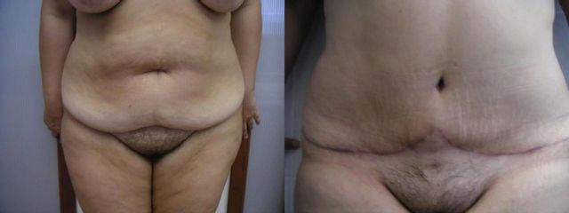ABDOMINOA PRED